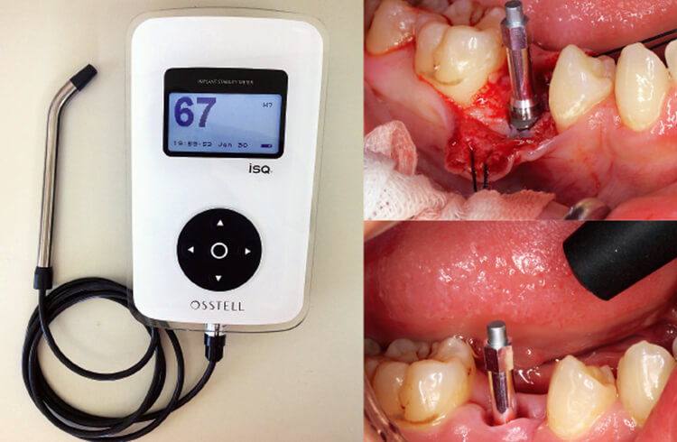 オステルISQアナライザ。外科処置時でも治癒期間中でも計測が可能。