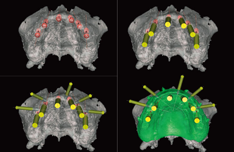 CT検査データを基にしたインプラントシミュレーションソフトによる設計。