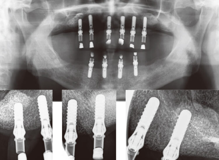 荷重後8週後のパノラマと口内法X線写真。骨吸収は認めない。