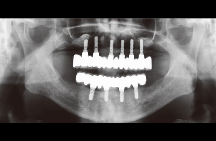 荷重後1年パノラマX線写真。骨吸収は認めない。