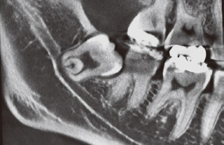20歳前後の患者の下顎埋伏智歯のレントゲン写真