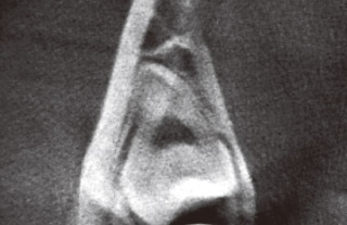 根尖部の歯根形態と下顎管の位置関係のレントゲン写真