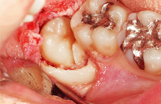 前方歯のアンダーカット部に引っかかる歯冠をダイヤモンドバーで切断した写真