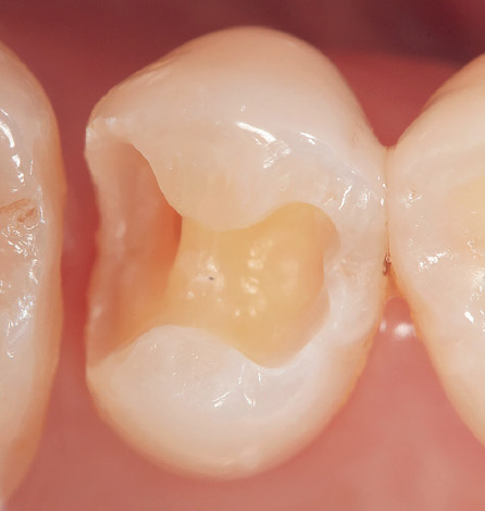 ケース1-1 右上第2小臼歯のメタルインレーをメタルフリーにしたいとの希望にて来院。インレー除去、再窩洞形成を行う。