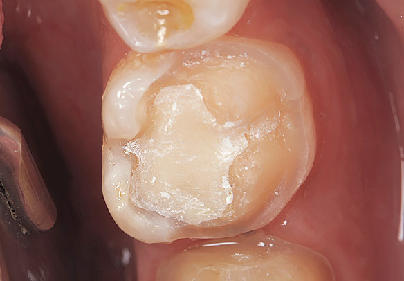 ケース2-1 右下第1大臼歯、機能咬頭を含むアンレータイプの形成を行う。健全歯質を極力残し歯肉縁上にフィニッシュラインを設定する。