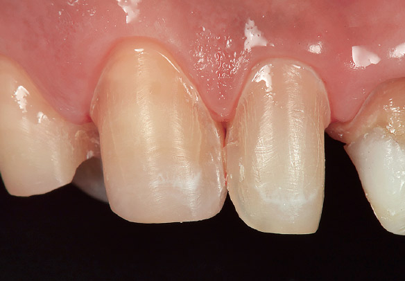 ケース3-1 右上側切歯、犬歯のラミネートベニア、第1小臼歯のアンレー形成を行った口腔内。
