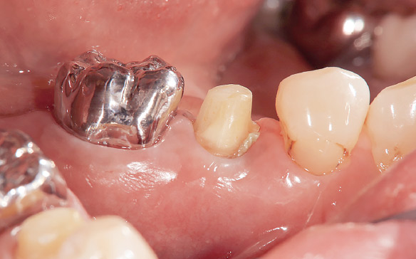 図2 支台歯頰側面観。セメントが入り込まないように歯肉圧排。