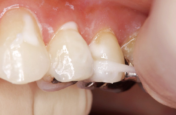 図19 隣接面には、スポンジ状のフロス（ライオン歯科材：DENT.ｅ-floss使用）を用いて塗布する。