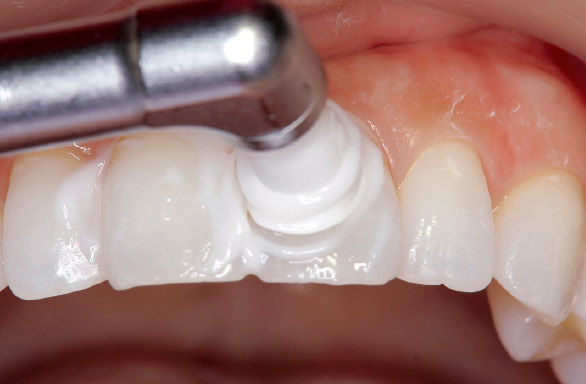 図11 上顎前歯部平滑面にはP・CSプロフィーカップソフトがフィットしやすい。