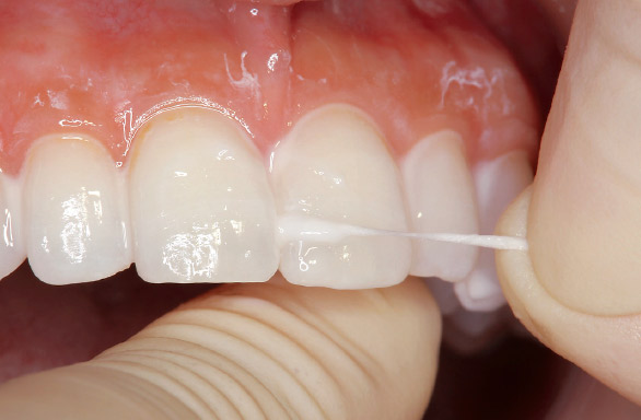 図12 隣接面には、スポンジ状のフロス（ライオン歯科材：DENT.ｅ-floss使用）を用いて塗布する。