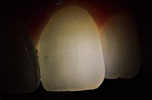 図15 術前クラック：トランスイルミネーターを口蓋側より当て、透過光で確認。