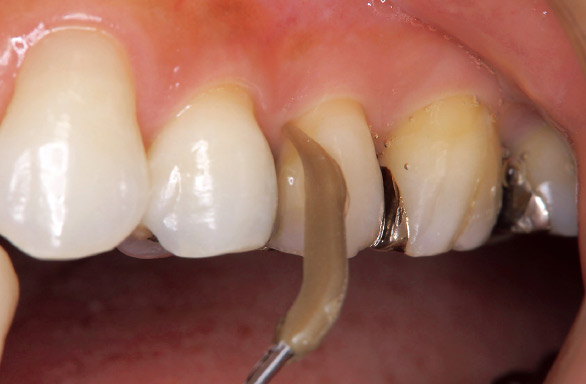 図17 知覚過敏：プラスチック製のチップを用いて非侵襲的な清掃をする。