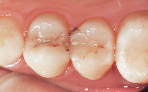図1 術前。左側上顎第一・第二小臼歯隣接部に変色と二次カリエスを伴う古いCR充填が認められる。