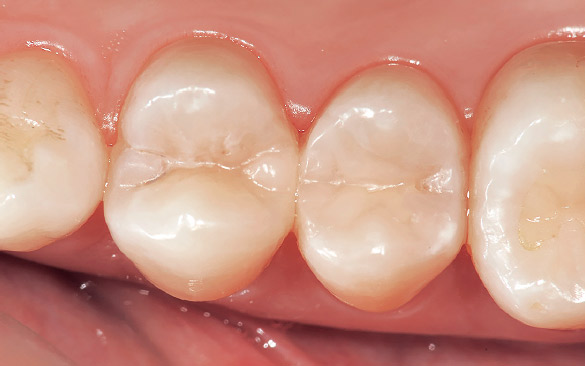 図12 術後。色調のみならず自然な隣接部の歯冠形態と接触点の回復ができたことにより、フロスによるメンテナンスも行えるようになった。