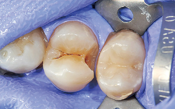 図2 第二小臼歯充填の後に第一小臼歯の充填物・感染歯質の除去を行った。