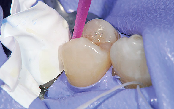 図4 隣接歯への汚染を防ぐためテフロンテープで保護し、エッチング・ボンディングを行う。