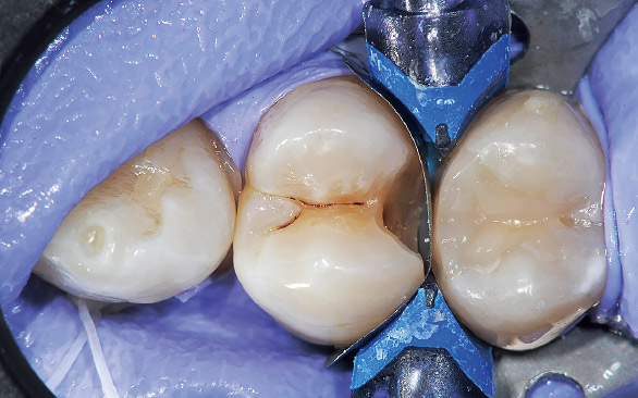 図8 隣接面コンタクトの回復のために歯間離開効果を持つコンポジタイト3Dリテーナー（スモール）を使用する。