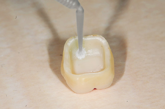 図5 クラウン内面にクリアフィルセラミックプライマープラスを塗布し乾燥する。
