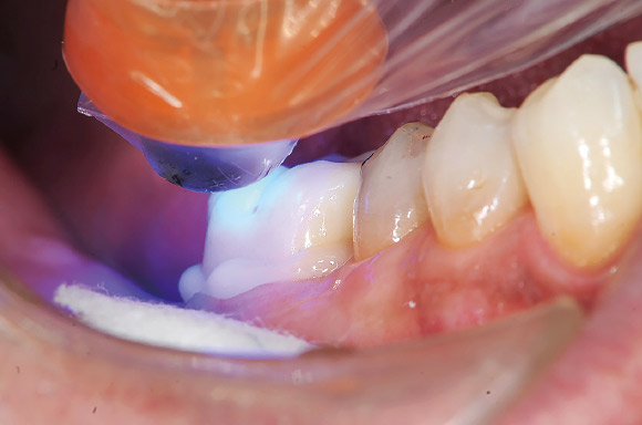 図7 パナビアV5クリアでクラウンを装着後5秒間光照射し予備重合させる。