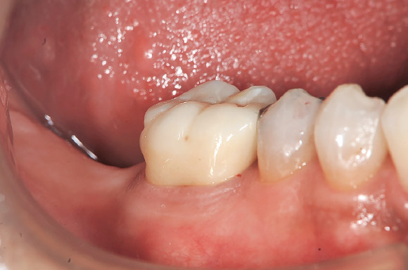 図9 術直後、歯肉の損傷もほとんど認めず良好な結果が得られた。