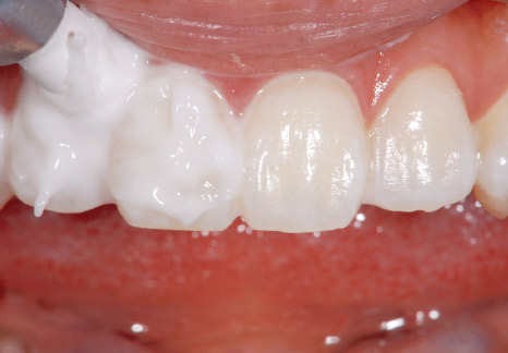 症例3−2 歯面全体を覆うぐらいペーストを塗布