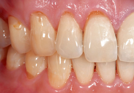 症例2−1 上顎右側の歯頸部に知覚過敏が認められた。