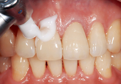 症例2−2 歯肉への付着も気にせず塗布。