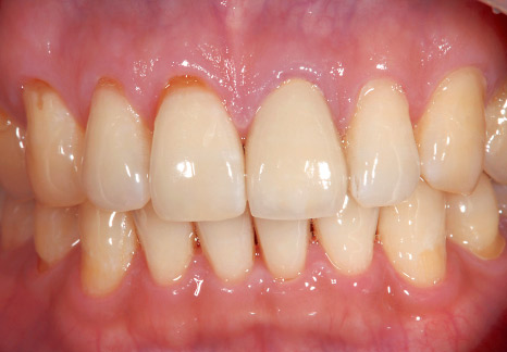 症例2−3 簡単に水洗でき、歯面に残りにくい。