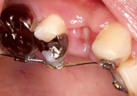 図5 便宜抜歯後の１週後の治癒状態