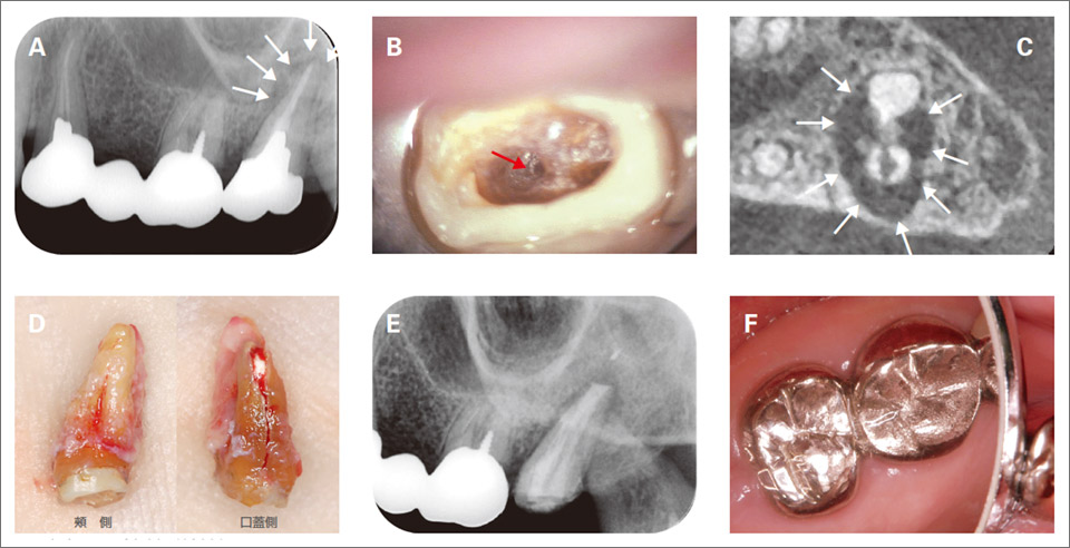 図6 根尖からの垂直歯根破折症例