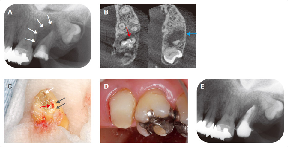 図7 穿孔を伴う根尖性歯周炎の症例