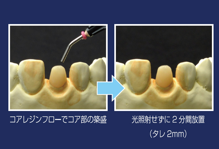 図3 i-TFCシステムコアレジンフローは垂れを抑えたローフロータイプ。