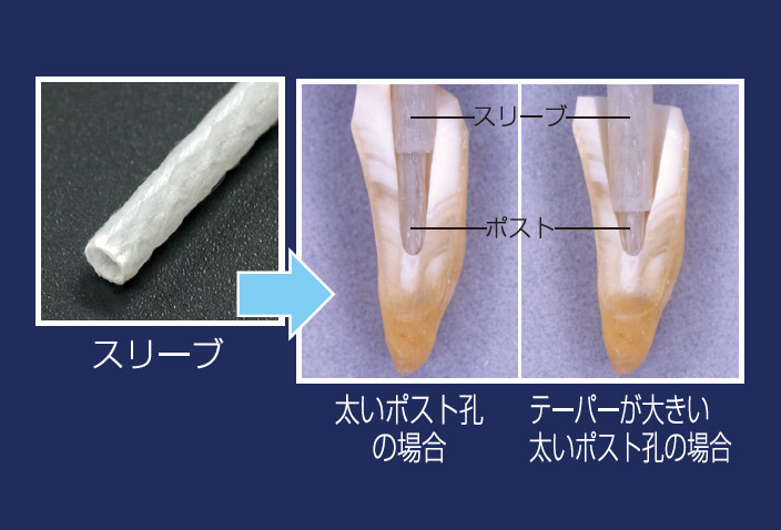 図5 i-TFCスリーブならびにファイバーポストとスリーブを併用した場合の断面。