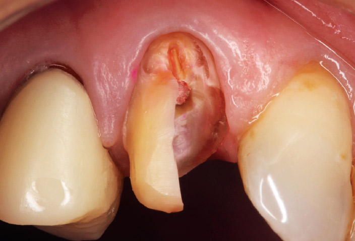 図11-a 3 根管処置歯