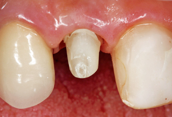 図12- l 支台歯形成後、プロビジョナルクラウンで辺縁歯肉のマネージメント終了時。