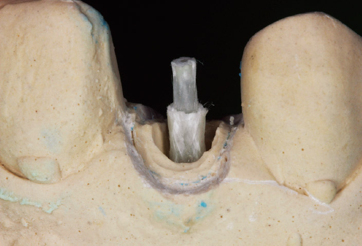 図12-c 作業模型上でファイバーポストとスリーブを組み合わせて調整し、試適した。