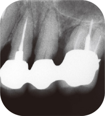図3 カリエスになる前の写真ー歯周病治療により露出した根面は3ヵ月に1度のメンテナンスで管理されていた。