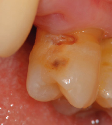 図5 義歯を外すとプラークコントロールが困難な隣接面に実質欠損を伴う根面カリエスが存在。