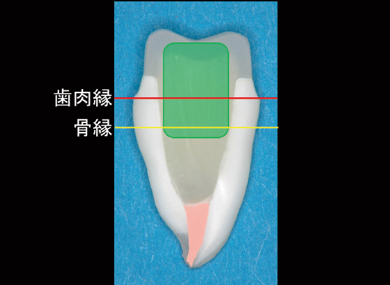 図2 緑枠の部分を補強する、という意識をもつことが大切である。水平的には全周かつ最外周に、垂直的には歯肉縁ラインをまたぐように配置するのが理想である。