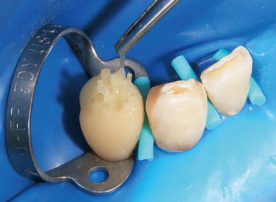 図23 i-TFCポストレジンを満たした後、アレンジメント通り光ファイバーポストを挿入していく。ポスト形状なのでハーフスリーブよりも挿入しやすい。