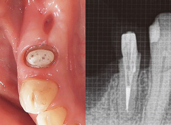 図24 十分に光照射ならびに重合を行った後、隔壁を除去し支台歯形成を行った。形成後の状態とデンタルX線写真を示す。ポストの挿入状態が確認できる。