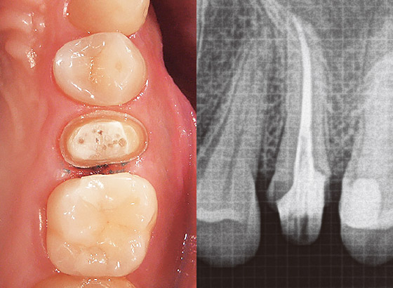 図18 十分に光照射ならびに重合を行った後、隔壁を除去し支台歯形成を行った。形成後の状態とデンタルX線写真を示す。ポストの挿入状態が確認できる。