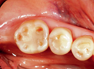 咬耗と酸蝕の合併症と考えられる咬合面の陥凹の写真