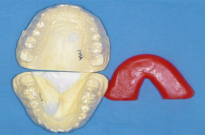 写真8 上下床と咬合採得用のパラフィンワックス