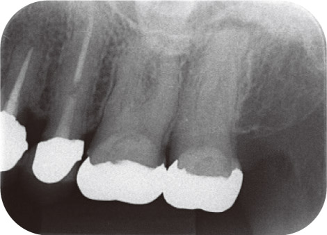 図1 66歳女性。上顎左側第二大臼歯の根尖病変。