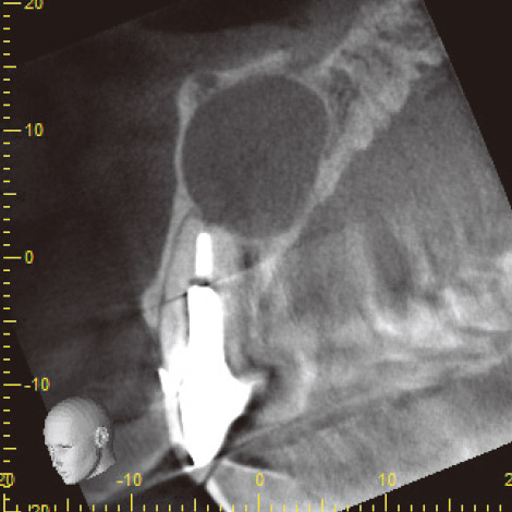 図11 CBCT側切歯断面像。