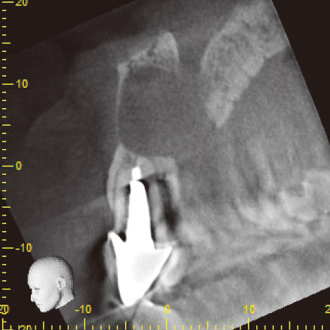図12 CBCT中切歯断面像。