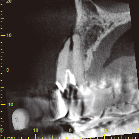 図14 CBCT唇口蓋側断面像。