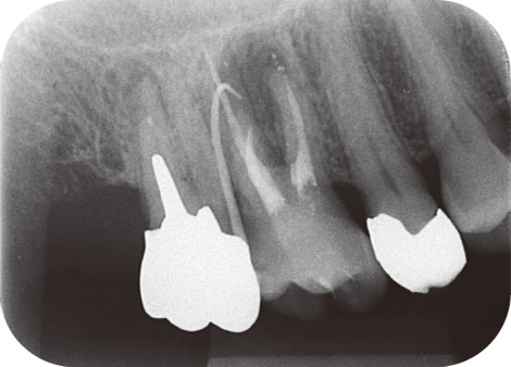 図15 58歳女性。上顎右側第一大臼歯。