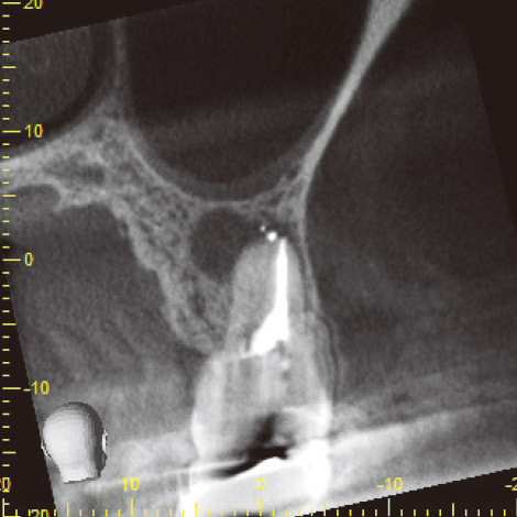 図16 CBCT頰口蓋断面像。